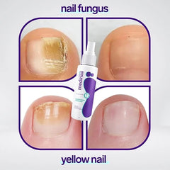 Jaysuing Nail Fungus Spray - Fast & Effective Treatment