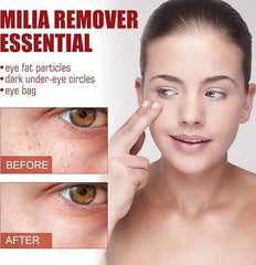 Smooth Milia Remover Serum - Clear & Hydrate Skin